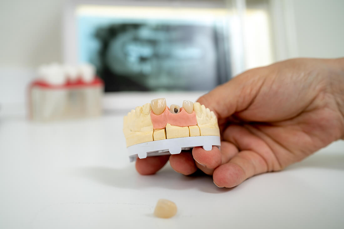 Zahnarztpraxis Duisburg-Nord - Kuchenbecker-Bohnen - Implantologie